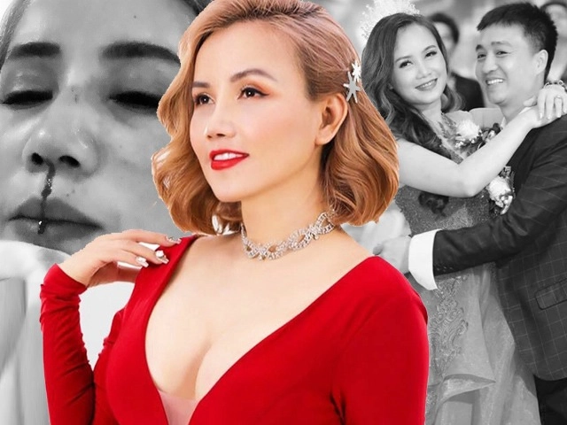 Nâng mũi như cuộc chạy đua với thời trang làm đủ kiểu cuối cùng vẫn quay về 1 dáng - 13
