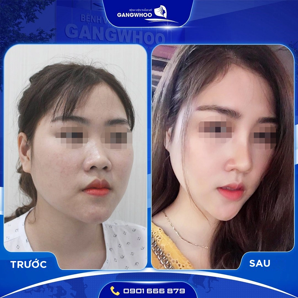 Nâng mũi sụn sườn có ưu điểm gì giá bao nhiêu - 3