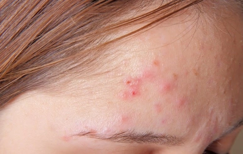 Nâng mũi xong về mụn nổi ầm ầm chị em bình tĩnh đọc kĩ bài viết này - 2