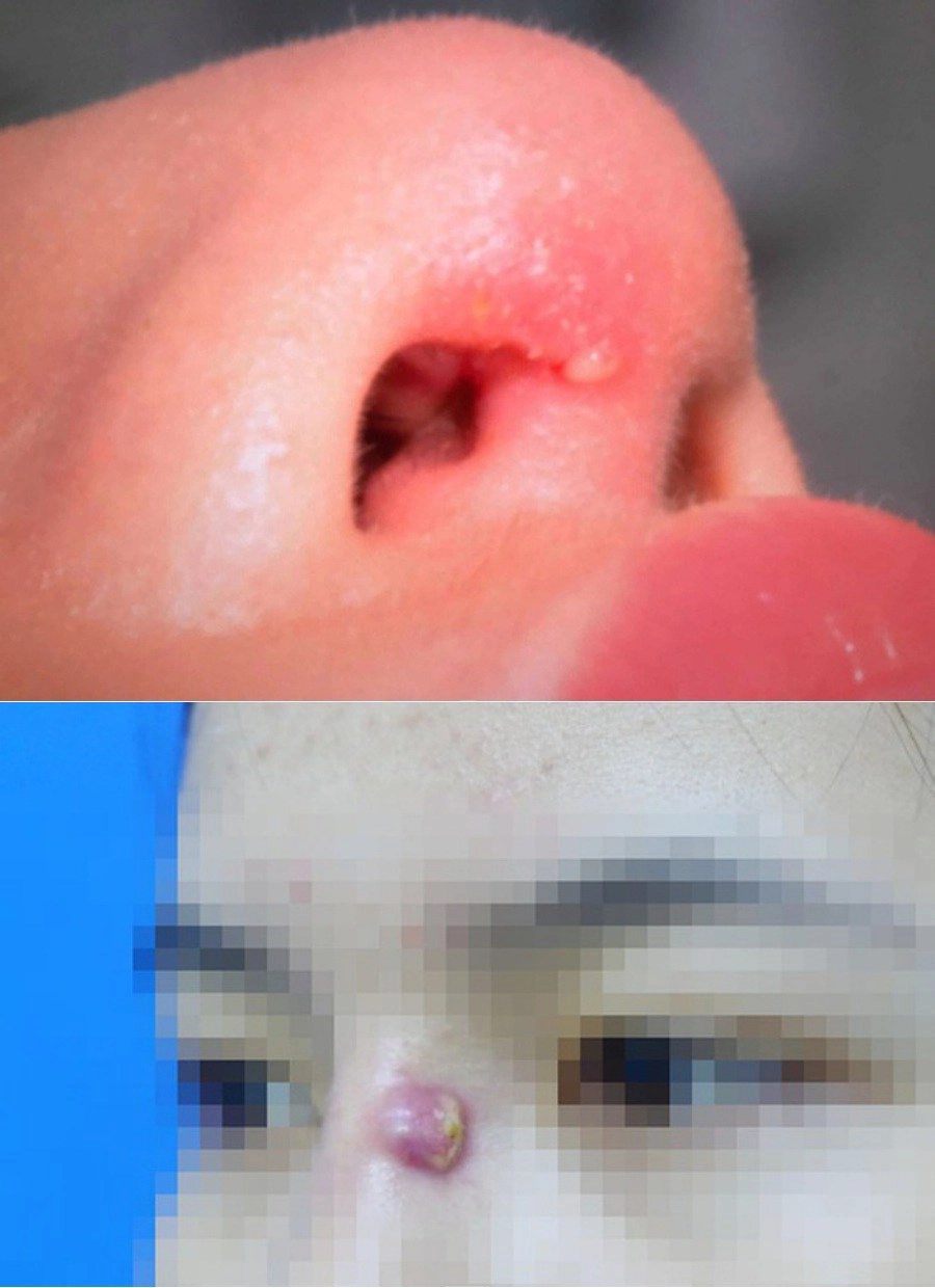 Nâng mũi xong về mụn nổi ầm ầm chị em bình tĩnh đọc kĩ bài viết này - 3