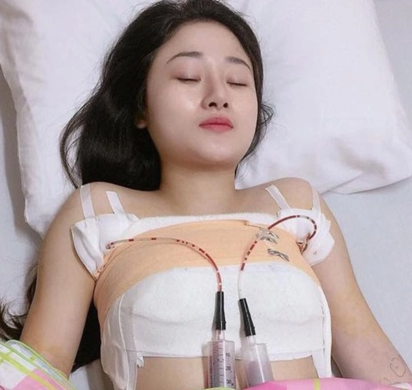 Nâng ngực chảy xệ sau sinh thuý diễm pha lê công khai đi đầu - 1
