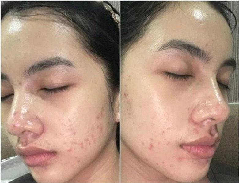 Ngày nào cẩm đan banh mặt vì mụn giờ là mỹ nhân mặt mộc nhờ sửa sai đúng 1 điều - 4