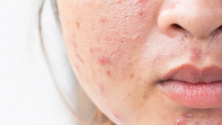 Ngày nào cẩm đan banh mặt vì mụn giờ là mỹ nhân mặt mộc nhờ sửa sai đúng 1 điều - 7