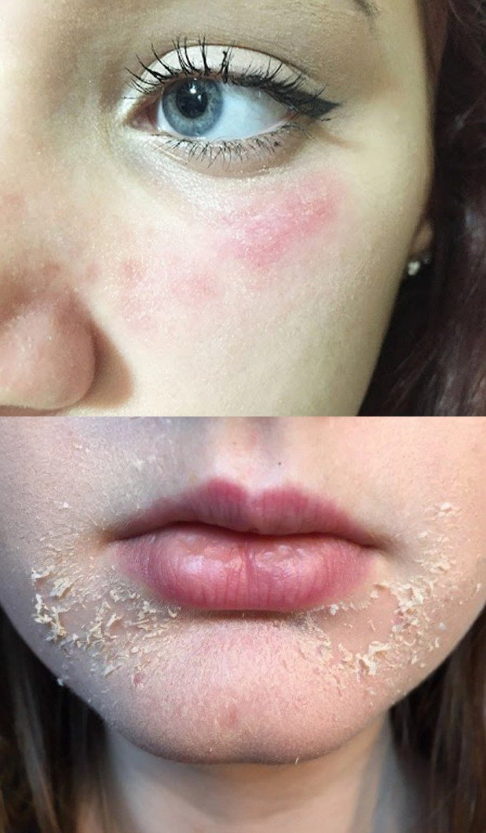 Nghe beauty blogger kể chuyện dùng retinoltretinoin chị em vơi bớt nỗi sợ nát mặt - 1