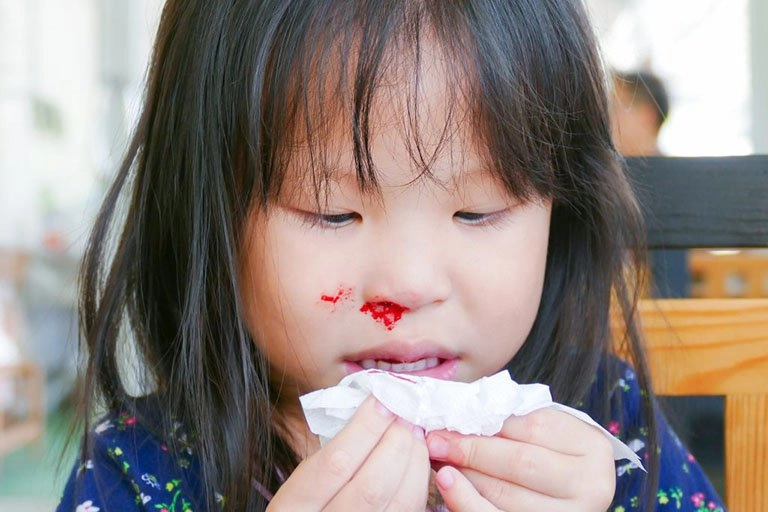 Nguyên nhân trẻ bị chảy máu cam do đâu - 1
