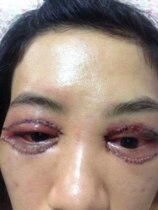 Những ca nhấn cắt mí thất bại nhất làm mạng xã hội bùng nổ - 13