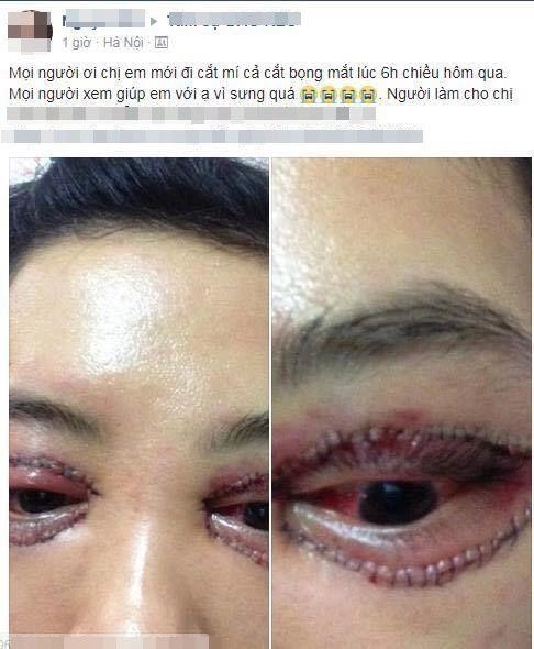 Những ca nhấn cắt mí thất bại nhất làm mạng xã hội bùng nổ - 14