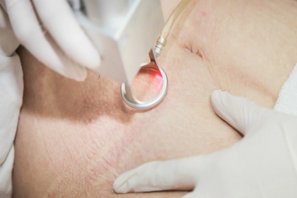 Những cách phổ biến để chữa rạn chùng da bụng sau sinh mà chị em cần lưu ý - 9