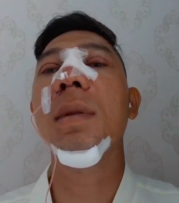 Những chiếc mí mắt sưng phù hậu dao kéo làm sao việt hoang mang - 1
