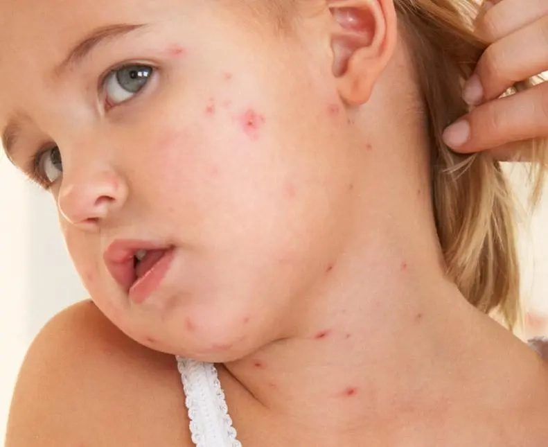 Phân độ chân tay miệng ở trẻ em như thế nào - 2