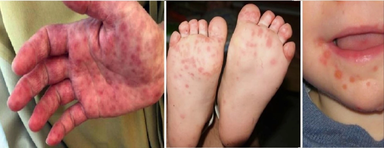 Phân độ chân tay miệng ở trẻ em như thế nào - 3
