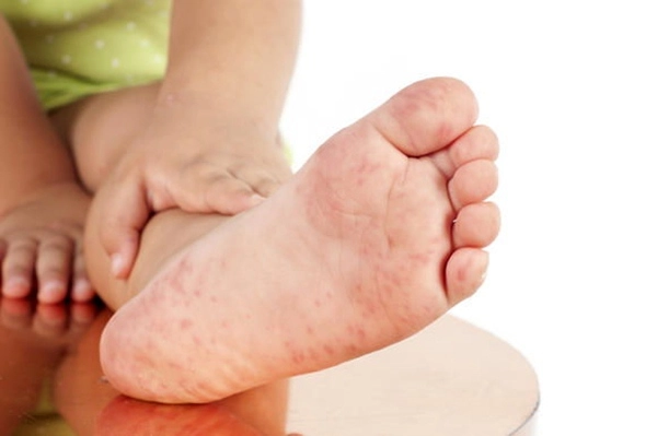 Phân độ chân tay miệng ở trẻ em như thế nào - 4