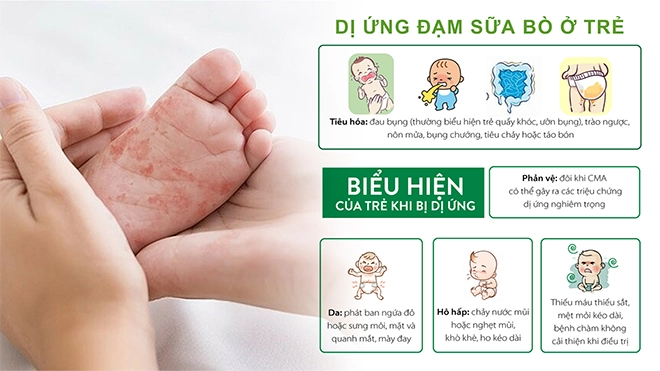 Phát hiện và can thiệp kịp thời trẻ bị dị ứng đạm sữa bò giúp trẻ phát triển khỏe mạnh - 1