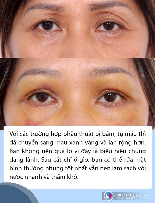 Phẫu thuật vùng mặt xong cần chăm sóc da và trang điểm thế nào để vừa xinh mà vẫn khoẻ - 6