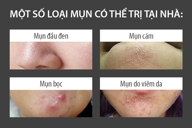 Rẻ-đẹp-dễ giãn cách chặn đứng shipper chị em tự tin cố thủ đánh bay mụn mủ với 3 món này - 2