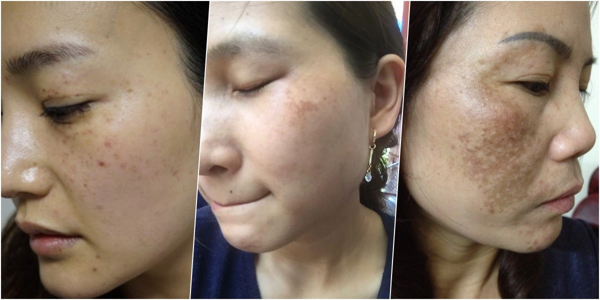 Rẻ-đẹp-dễ việt nam may mắn có 1 loại lá chuyên trị nám tìm đâu cũng có - 1