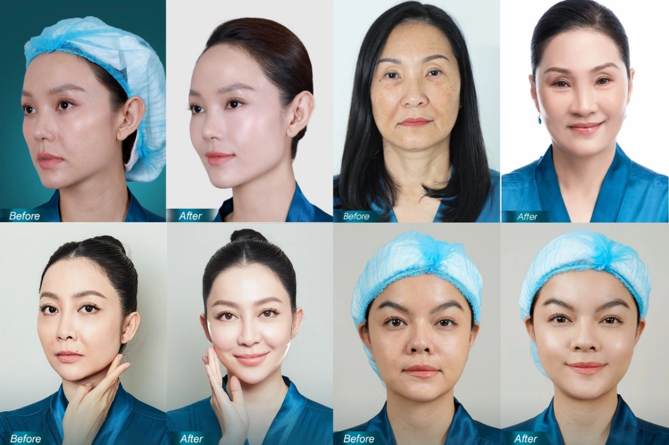 Ruco trở thành nơi có số ca điều trị nâng cơ ultherapy - 3