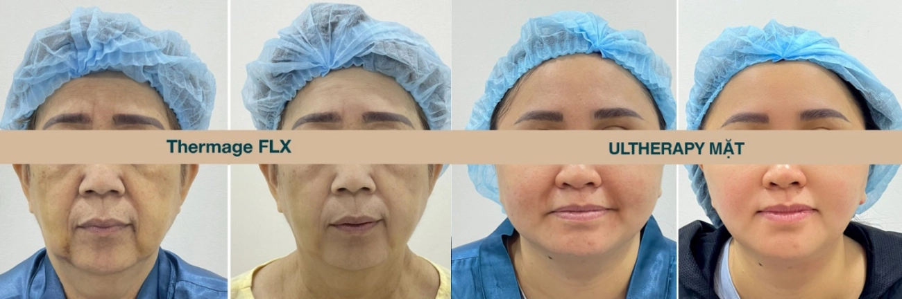 Ruco trở thành nơi có số ca điều trị nâng cơ ultherapy - 4