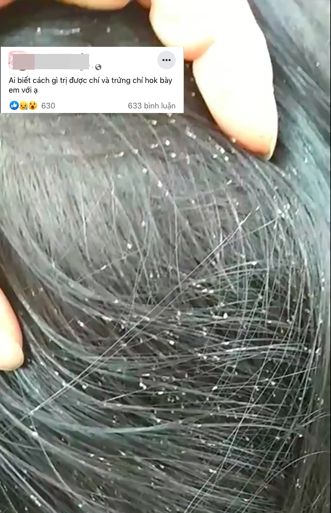 Rùng mình cách các mẹ trị chấy tóc cho con duỗi ép không xi nhê đặc trị bằng bột giặt - 1