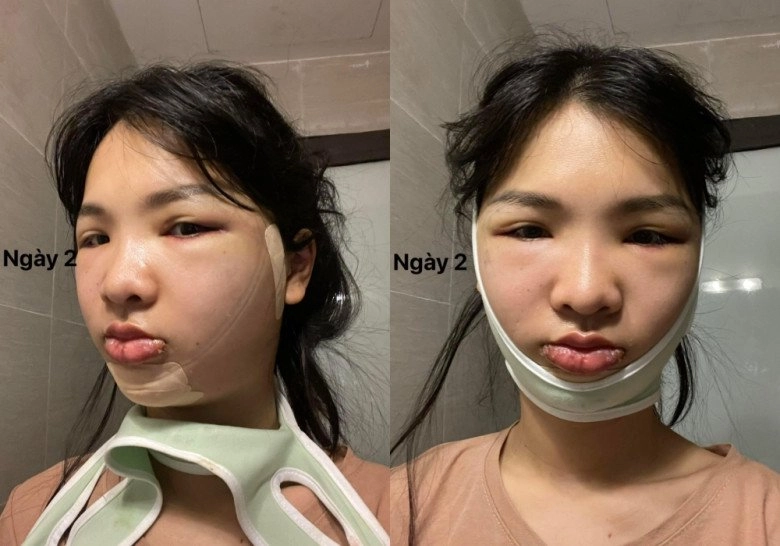 Rùng mình chiến tích gái xinh đem về hậu gọt hàm hạ gò má trượt cằm - 5