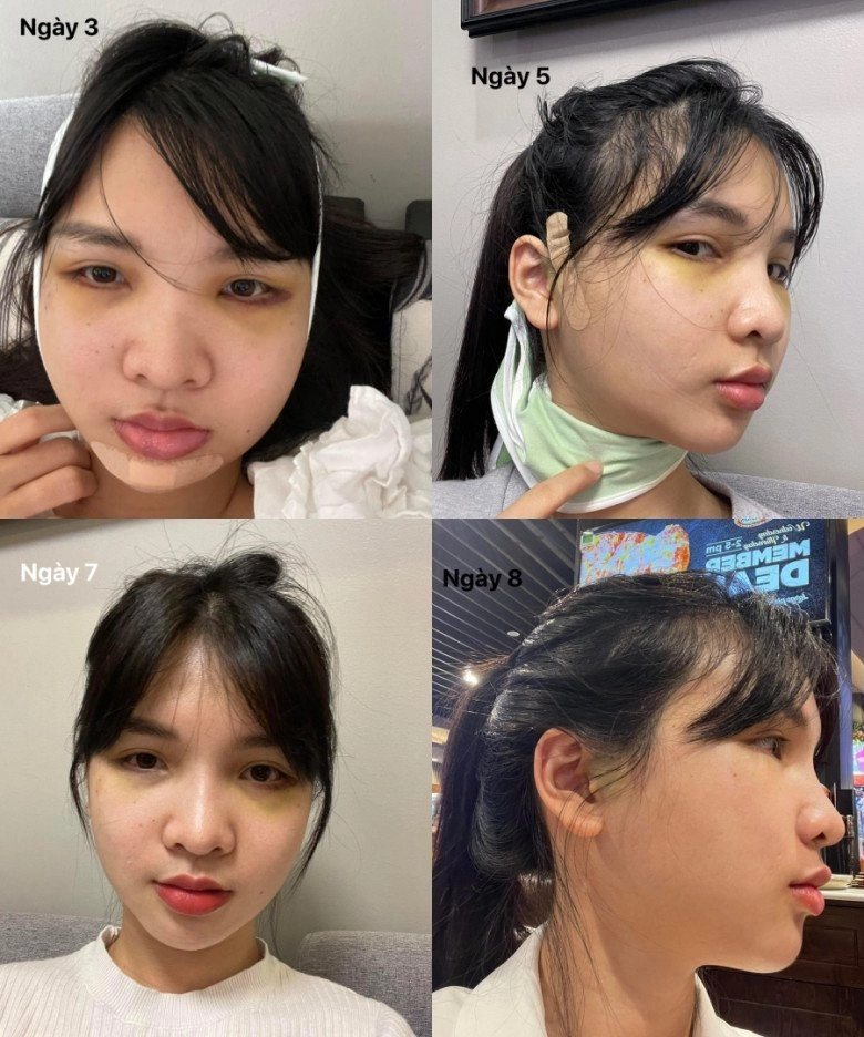 Rùng mình chiến tích gái xinh đem về hậu gọt hàm hạ gò má trượt cằm - 6