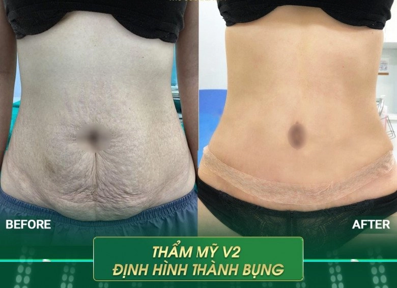 Sau nhiều năm hút mỡ bụng tạo hình chiếc rốn của thúy vi trông lạ lẫm - 9