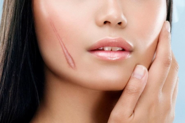 Sẹo lồi nguyên nhân và cách chữa trị hiệu quả an toàn - 1