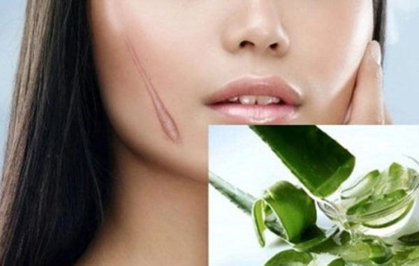 Sẹo lồi nguyên nhân và cách chữa trị hiệu quả an toàn - 11