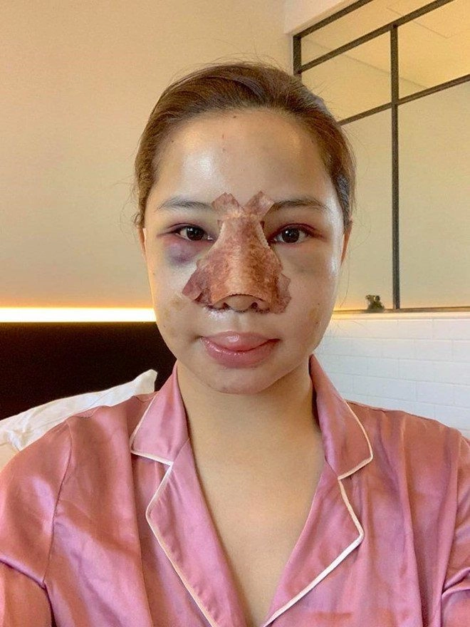 Tại sao gương mặt thường phù lên sau pttm có nguy hiểm không - 7