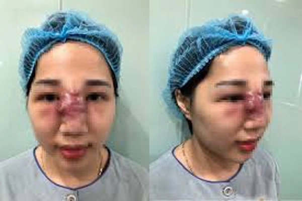 Tại sao gương mặt thường phù lên sau pttm có nguy hiểm không - 12