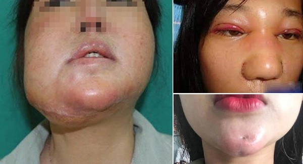 Tại sao gương mặt thường phù lên sau pttm có nguy hiểm không - 13