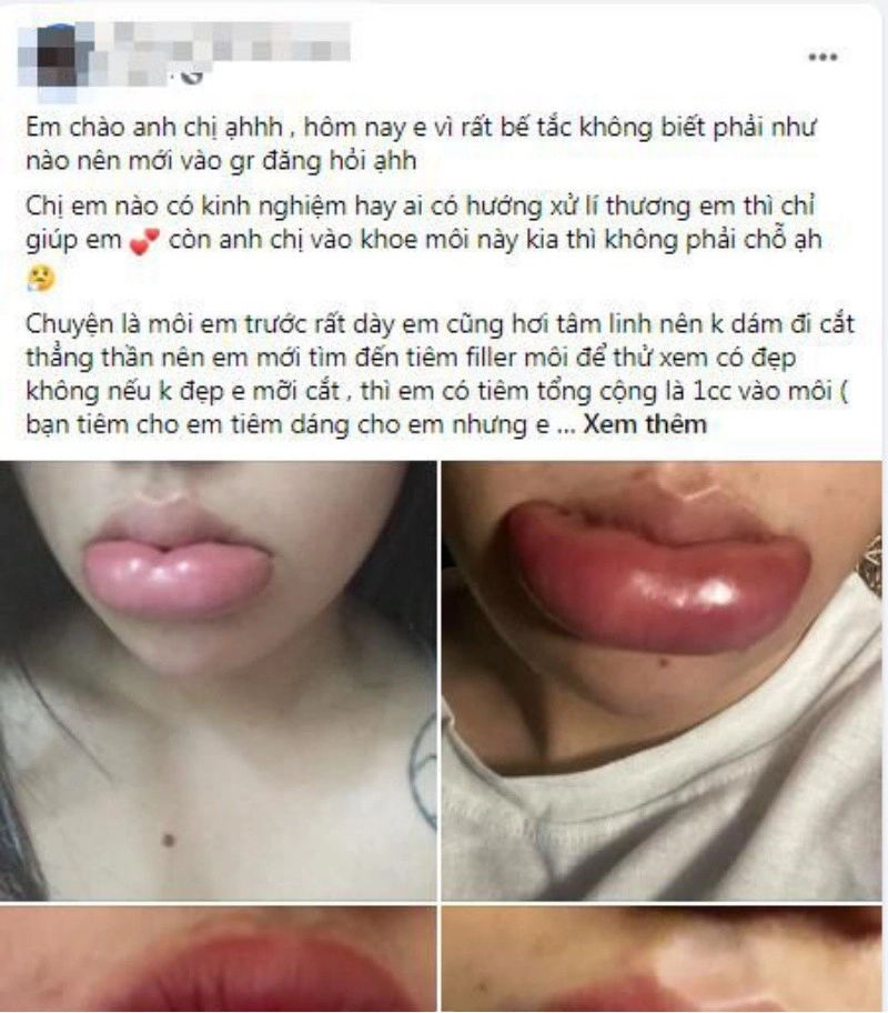 Tâm linh không dám đi cắt môi gái xinh mạnh dạn tiêm filler nhận ngay đôi môi hệt gái ngành - 2