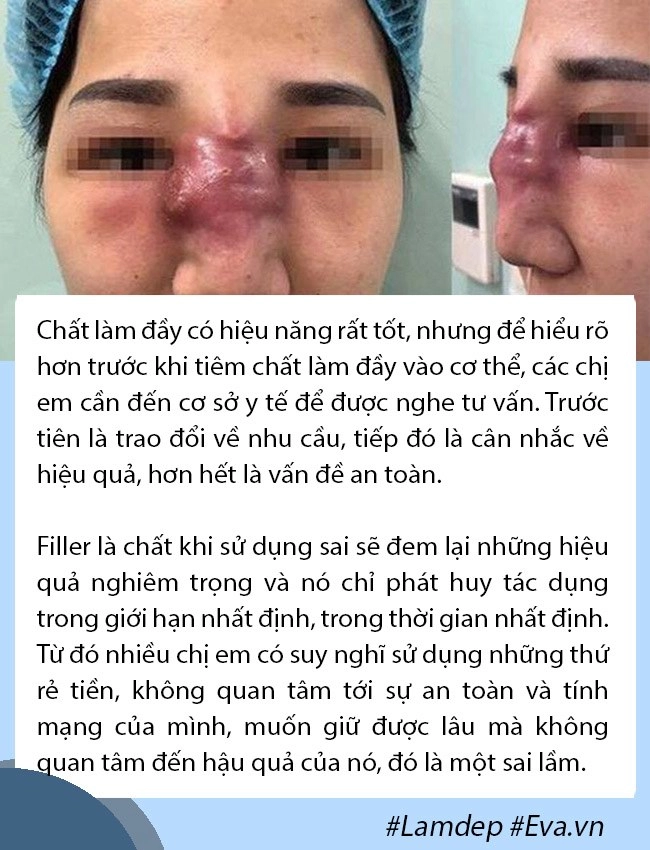 Tâm linh không dám đi cắt môi gái xinh mạnh dạn tiêm filler nhận ngay đôi môi hệt gái ngành - 10