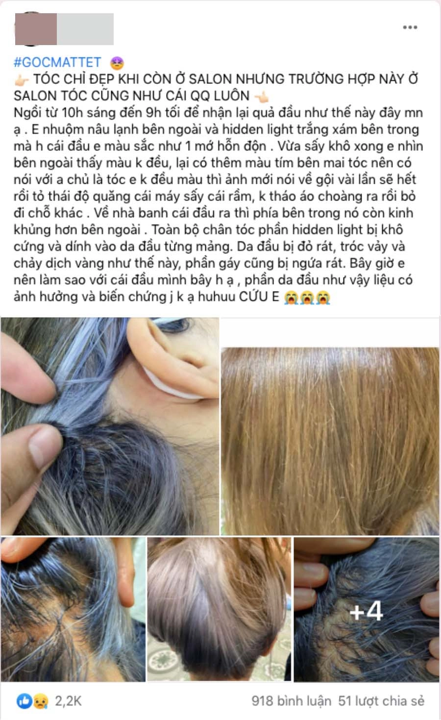Tẩy tóc chơi tết gái xinh ngồi 11 tiếng nhận về cái kết cháy da đầu chảy dịch mủ - 1