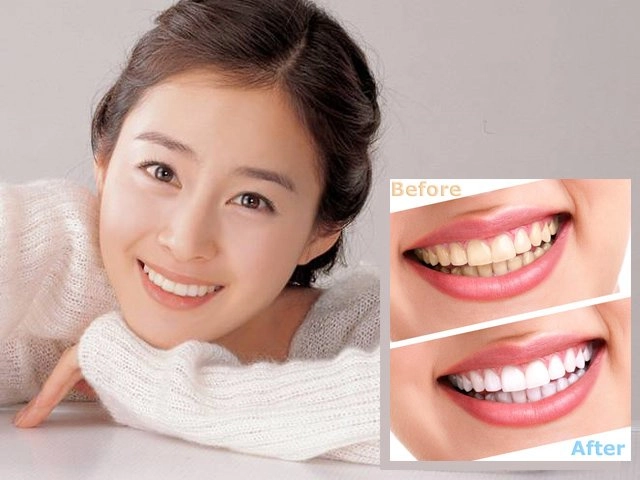 Tẩy trắng răng có hại gì với sức khỏe và những đối tượng không nên tẩy - 10