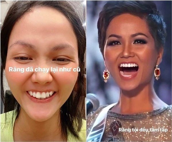 Thẩm mỹ nụ cười được nhiều hoa hậu ứng dụng như thế nào - 3