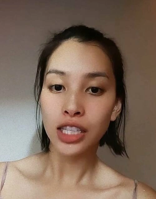 Thẩm mỹ nụ cười được nhiều hoa hậu ứng dụng như thế nào - 8