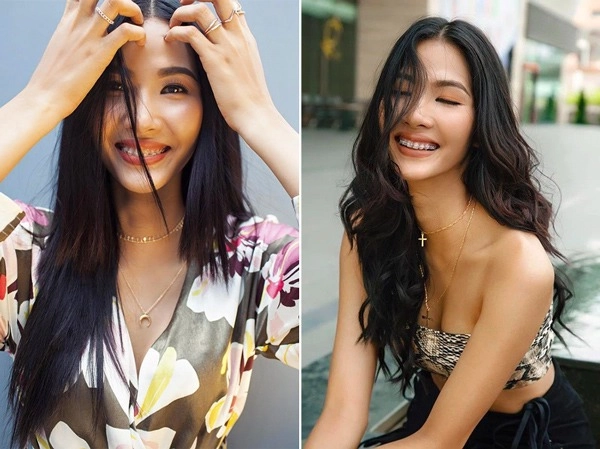 Thẩm mỹ nụ cười được nhiều hoa hậu ứng dụng như thế nào - 9