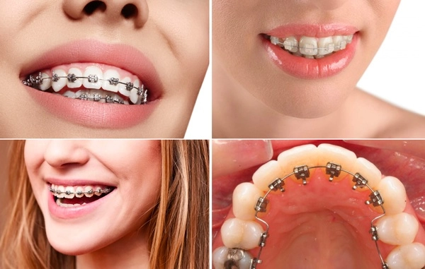 Thẩm mỹ nụ cười được nhiều hoa hậu ứng dụng như thế nào - 22