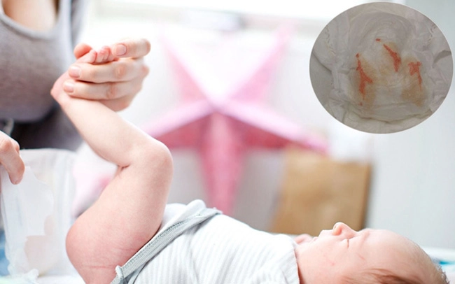 Thay tã cho con sơ sinh mẹ hoảng hồn khi phát hiện bên trong có máu vội vàng nhập viện - 3