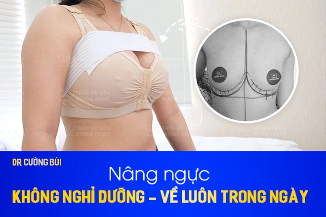 Nâng ngực nội soi khe khít cùng bác sĩ thẩm mỹ cường bùi - 2