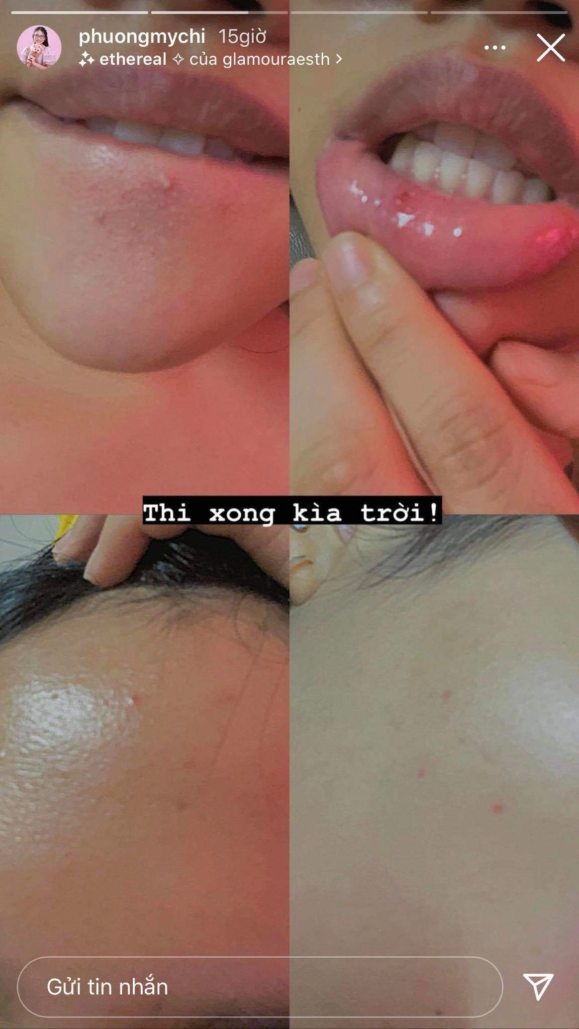 Thi cử căng thẳng phương mỹ chi chụp cận cảnh làn da toang mạnh ai nấy đều thương - 2