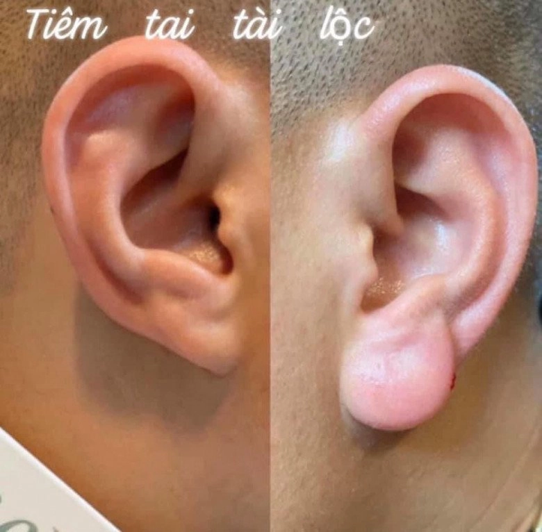 Tiêm tai phật để đổi vận nhiều người đau đớn vì phải phẫu thuật để chữa lành - 3