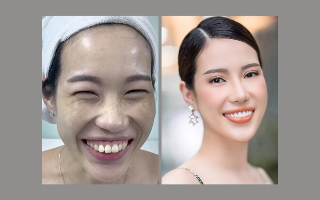 Tmv ngọc dung tái xuất hai công nghệ kỉ lục về số ca trẻ hóa và giảm mỡ - 4