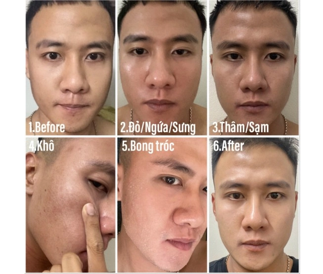 Tóc tiên và quỳnh anh shyn liên tiếp gặp tai nạn về chăm sóc da - 4