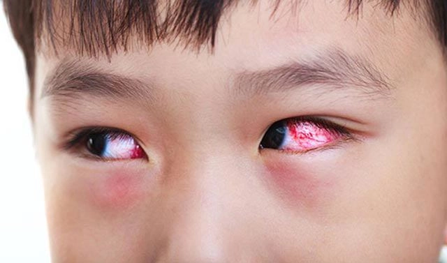 Trẻ bị đau mắt đỏ kiêng gì và ăn gì nhanh khỏi - 1