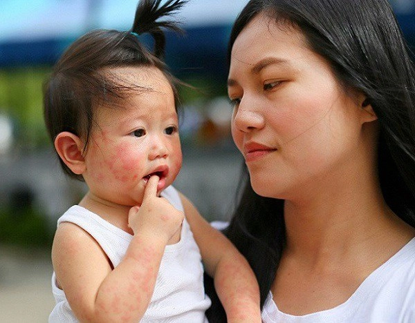 Trẻ bị tay chân miệng có kiêng tắm không - 2
