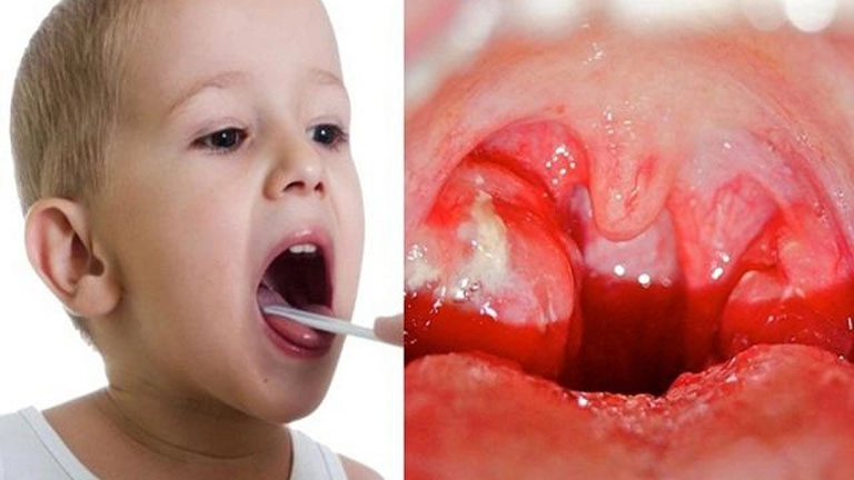 Trẻ bị viêm amidan phải xử lý như thế nào - 1