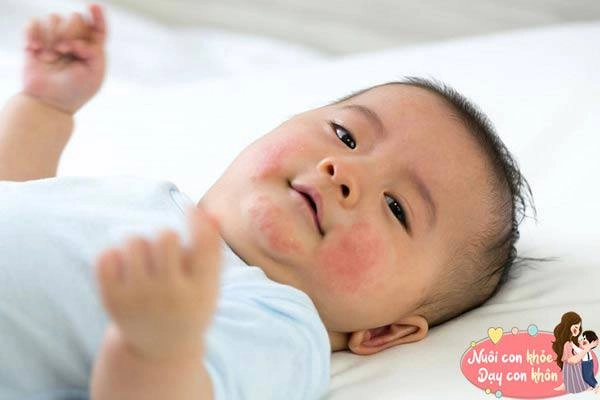 Trẻ dị ứng sữa bò thiếu canxi bs mách cách thay thế dễ làm đủ chất cho con lớn nhanh - 5