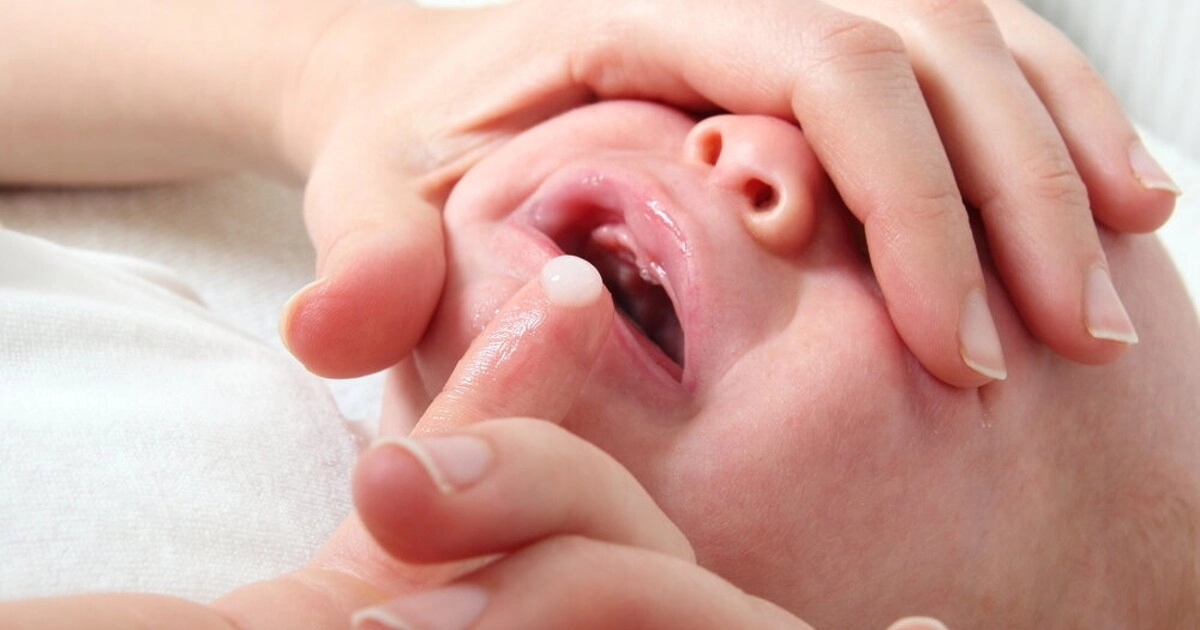 Trẻ sơ sinh bị nấm miệng phải làm sao - 1